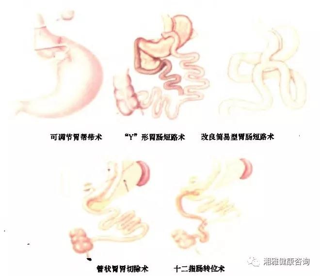 肠-胰岛轴机制