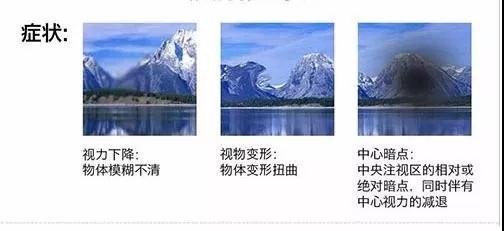 黄斑变性-中南大学湘雅三医院健康管理中心