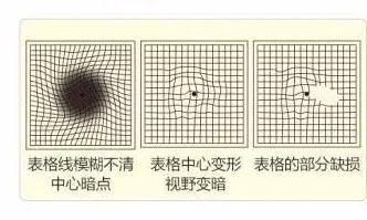 黄斑变性-中南大学湘雅三医院健康管理中心